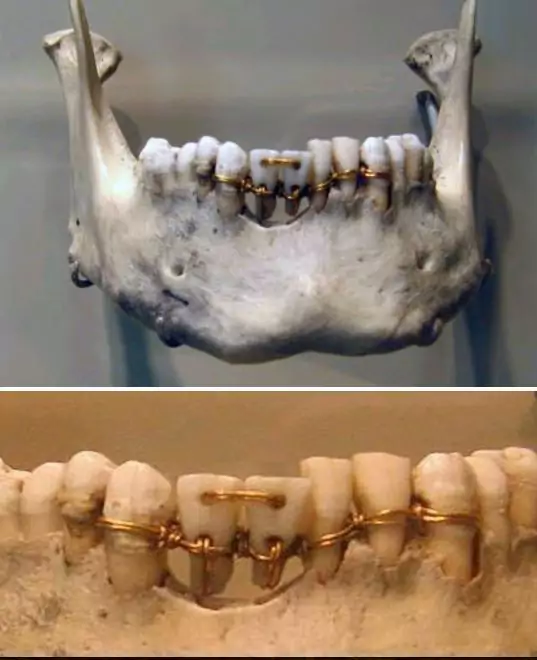 Skull showing gold wires keeping the front teeth in place